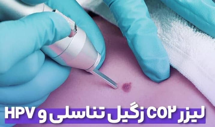 زگیل برداری میخچه برداری و...|خدمات آرایشگری و زیبایی|ارومیه, |دیوار