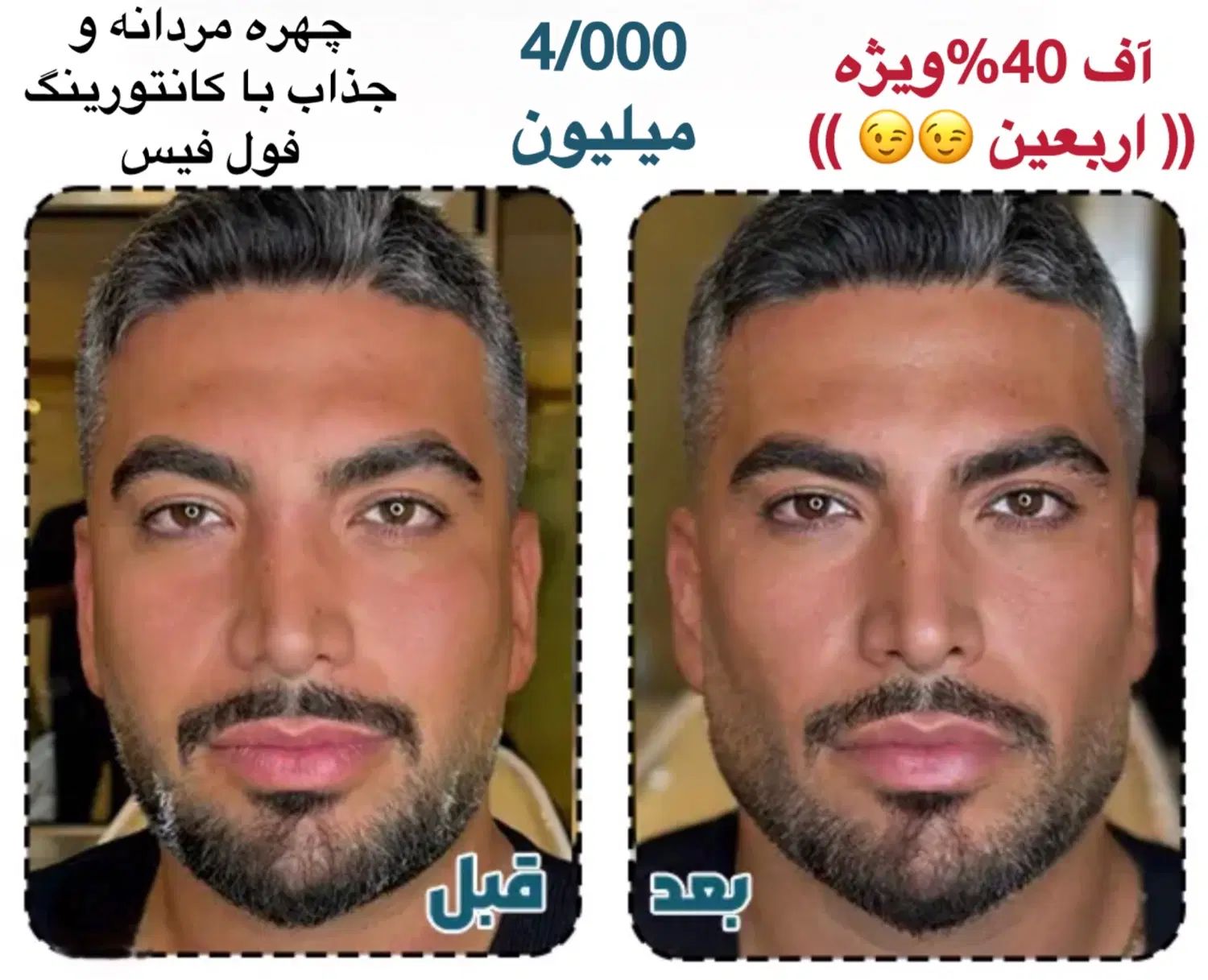 تزریق ژل لب بوتاکس کانتورینگ صورت جوانسازی لیفت|خدمات آرایشگری و زیبایی|تهران, صادقیه|دیوار