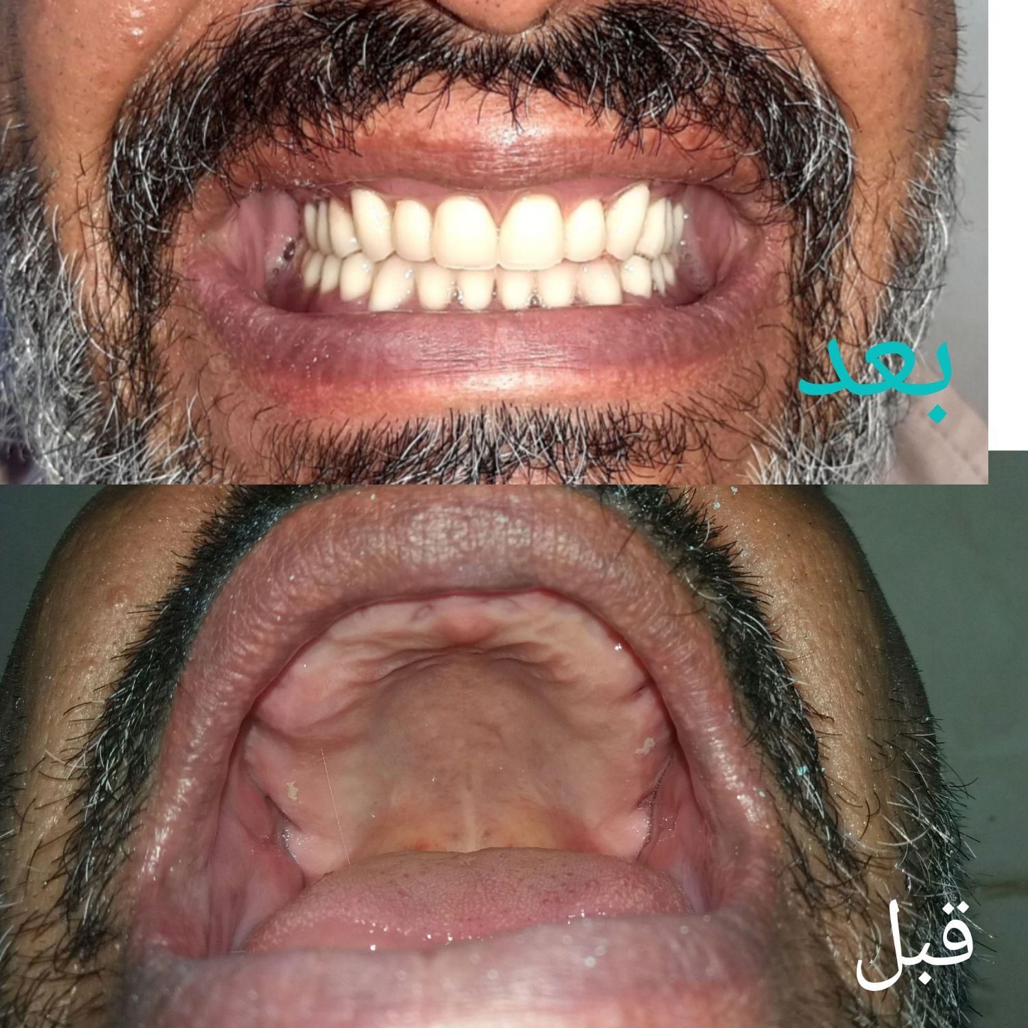 ساخت دندان مصنوعی اقتصادی وبا کیفیت|خدمات آرایشگری و زیبایی|ری, دیلمان|دیوار