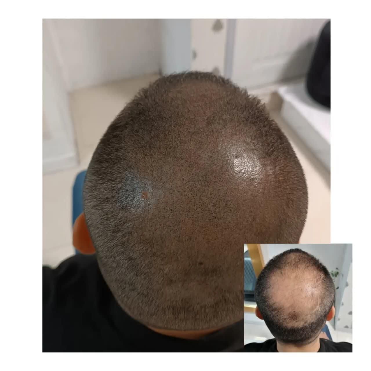 آموزش خدمات میکرواسکالپ کاشت اسکالپ مو تضمینی|خدمات آرایشگری و زیبایی|مشهد, جانباز|دیوار