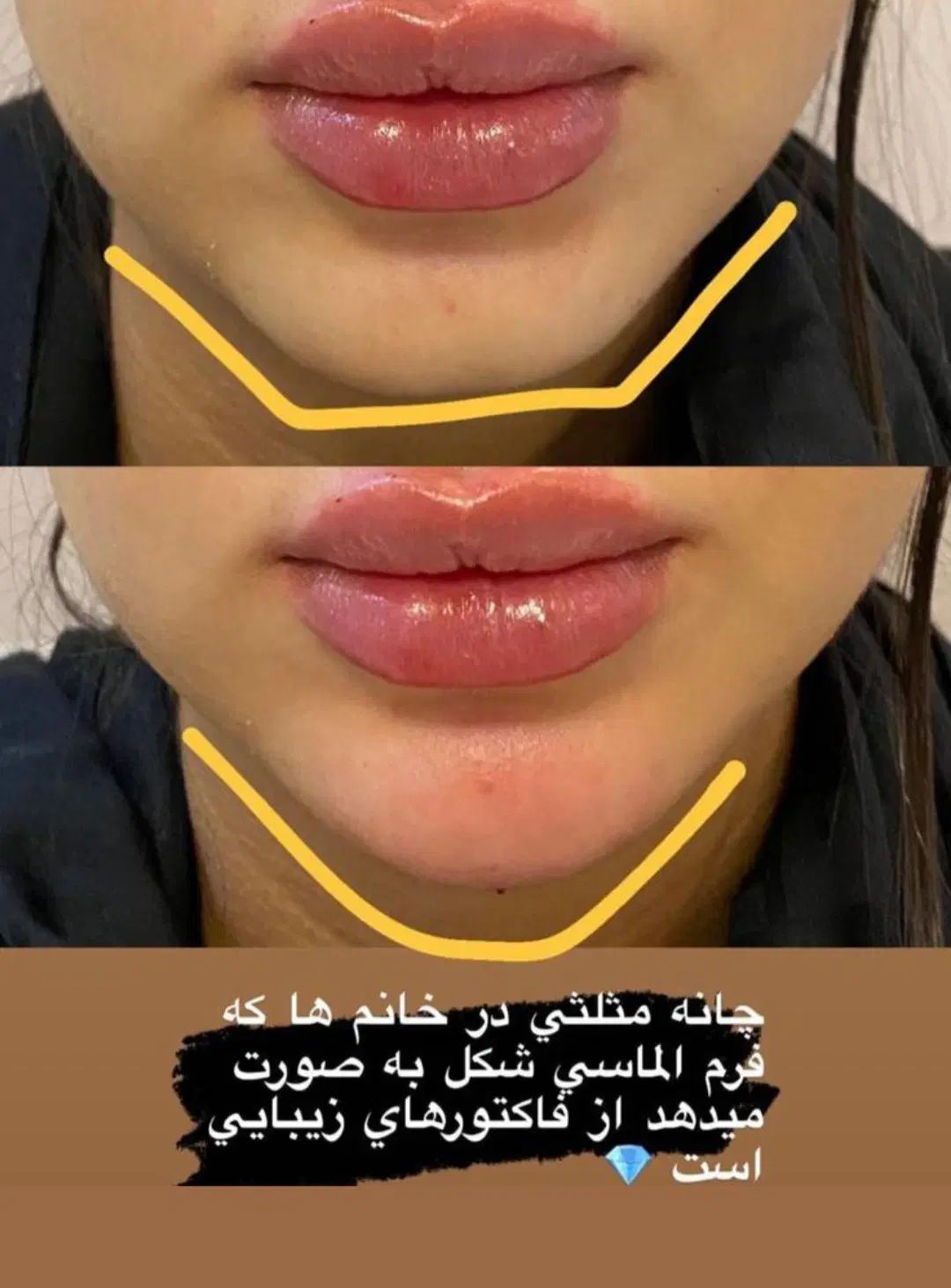 تزریق ژل فیلر بوتاکس مزوتراپی مزوژل لیزر فیشیال|خدمات آرایشگری و زیبایی|کرج, گوهردشت|دیوار