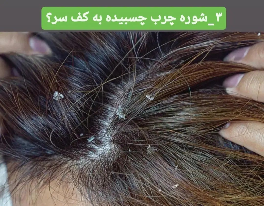 پاکسازی کف سر،درمان ریزش،شوره چربی سروضخیم سازی مو|خدمات آرایشگری و زیبایی|نیشابور, هفده شهریور|دیوار