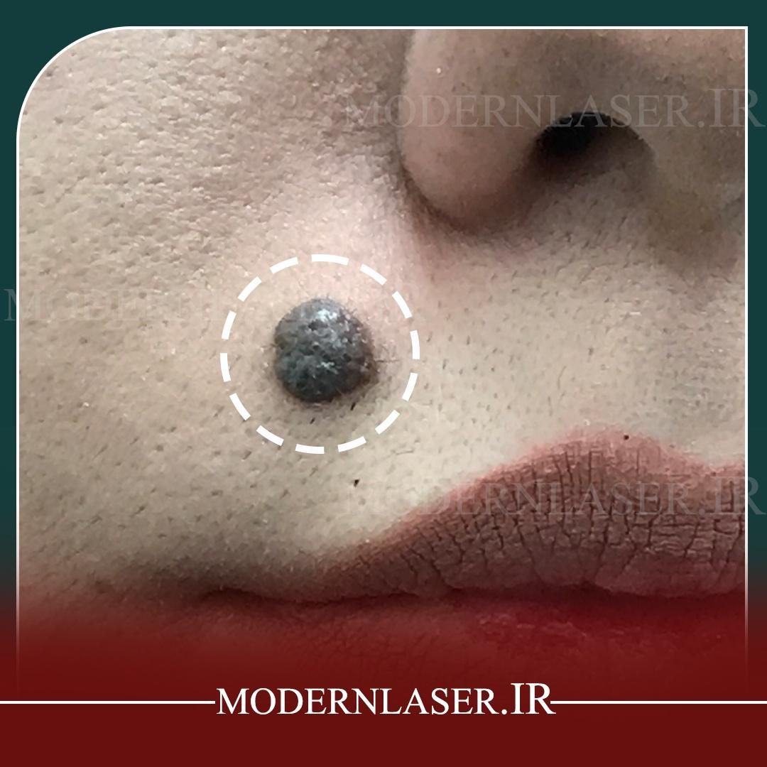 درمان کامل انواع خال و زائده های پوستی بدون بازگشت|خدمات آرایشگری و زیبایی|اصفهان, سعادت‌آباد|دیوار