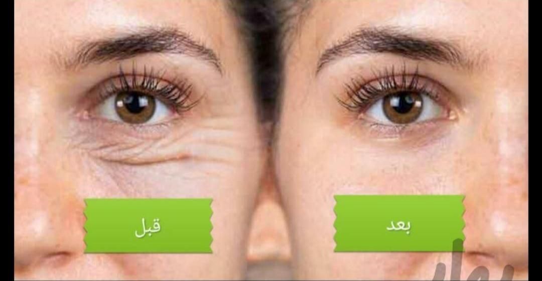 رفع افتادگی پلک/،رفع پف زیر چشم|خدمات آرایشگری و زیبایی|اصفهان, اندوان|دیوار