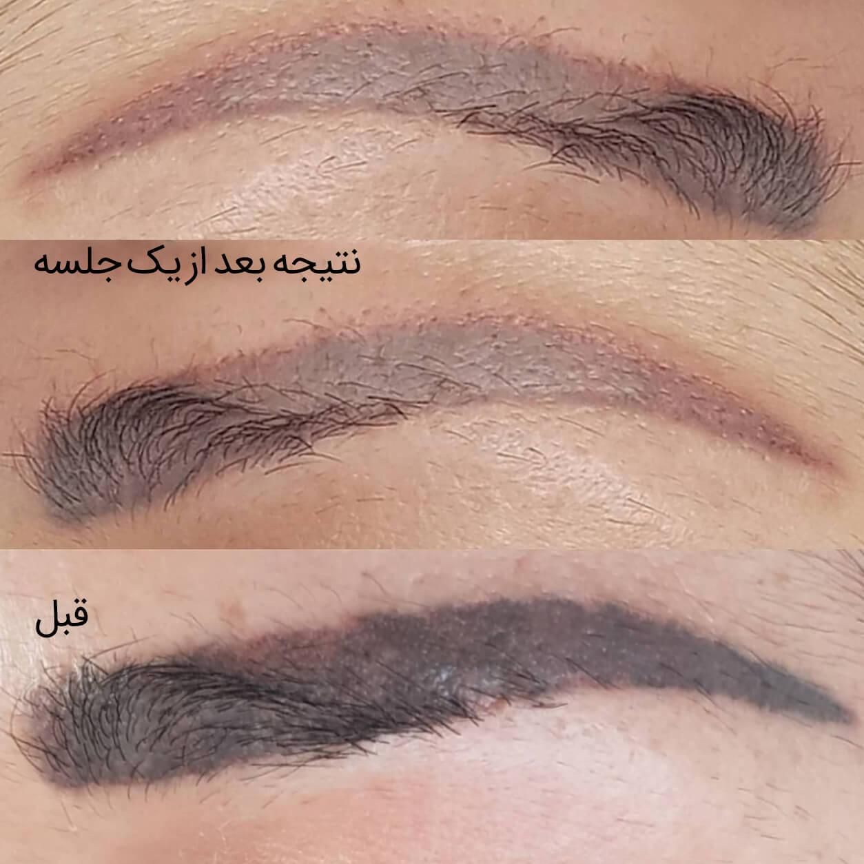 پاک کردن و ریموو تاتو صورت بدون عوارض و در یک جلسه|خدمات آرایشگری و زیبایی|تهران, دهکده المپیک|دیوار