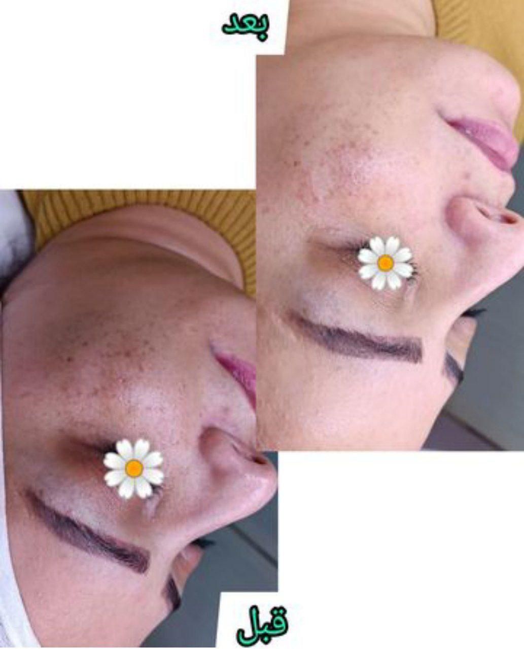 فشیال وپاکسازی صورت|خدمات آرایشگری و زیبایی|نیشابور, شهرک اندیشه|دیوار