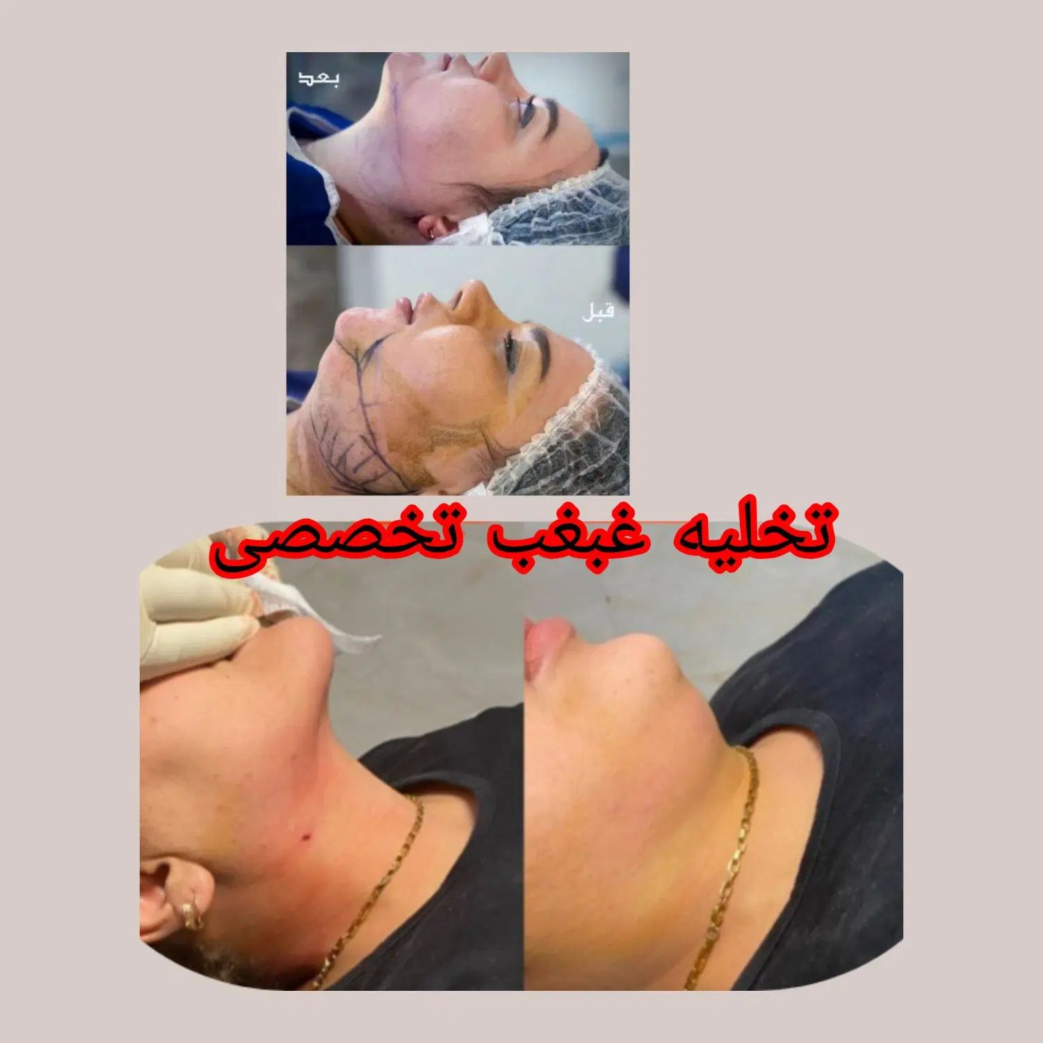 تزریق چربی. .مادلینگ .شکم .پهلو درکلینیک تخصصی|خدمات آرایشگری و زیبایی|کرمانشاه, |دیوار