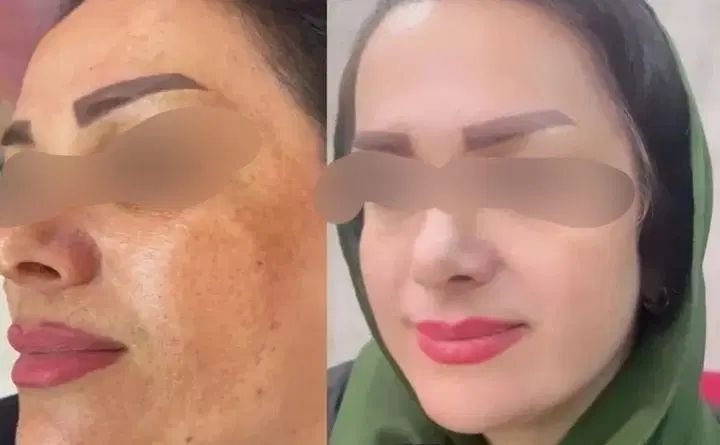 کرم عربی ۴۵ترکیب گیاهی جدیدترین کرم سال|آرایشی، بهداشتی، درمانی|یزد, |دیوار