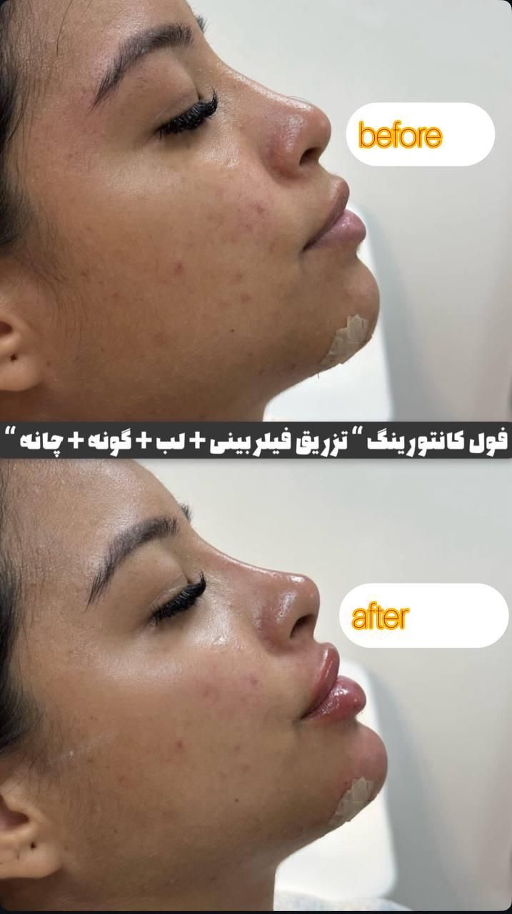 ژل و بوتاکس مرو فیلر توسط دکتر تخفیف ۳۰ ٪|خدمات آرایشگری و زیبایی|مشهد, کوثر|دیوار