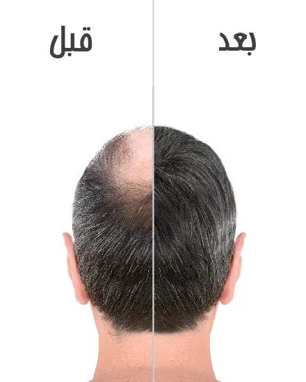 مشاوره مو|فعالیت داوطلبانه|مشهد, کلاهدوز|دیوار