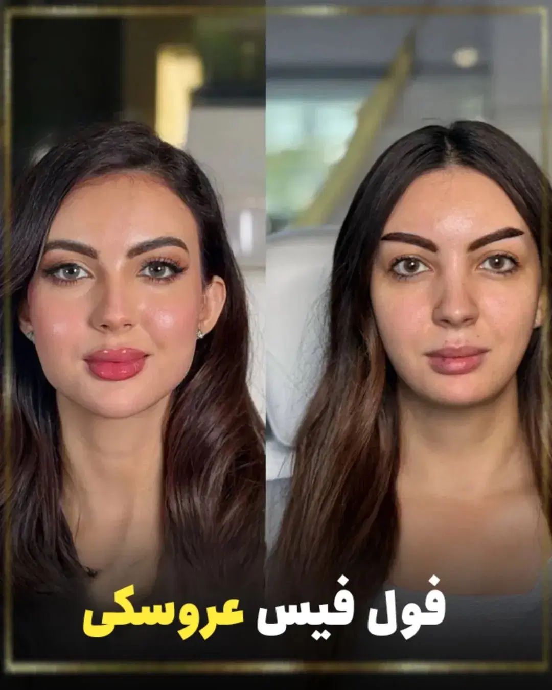 کلینیک زیبایی ژل لب روسی فیلر زاویه مزوبوتاکس لیزر|خدمات آرایشگری و زیبایی|شهریار, شهریار|دیوار