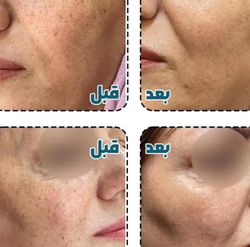 فروش مواد زگیل تناسلی تضمینی با ی بار استفاده|خدمات آرایشگری و زیبایی|یاسوج, |دیوار