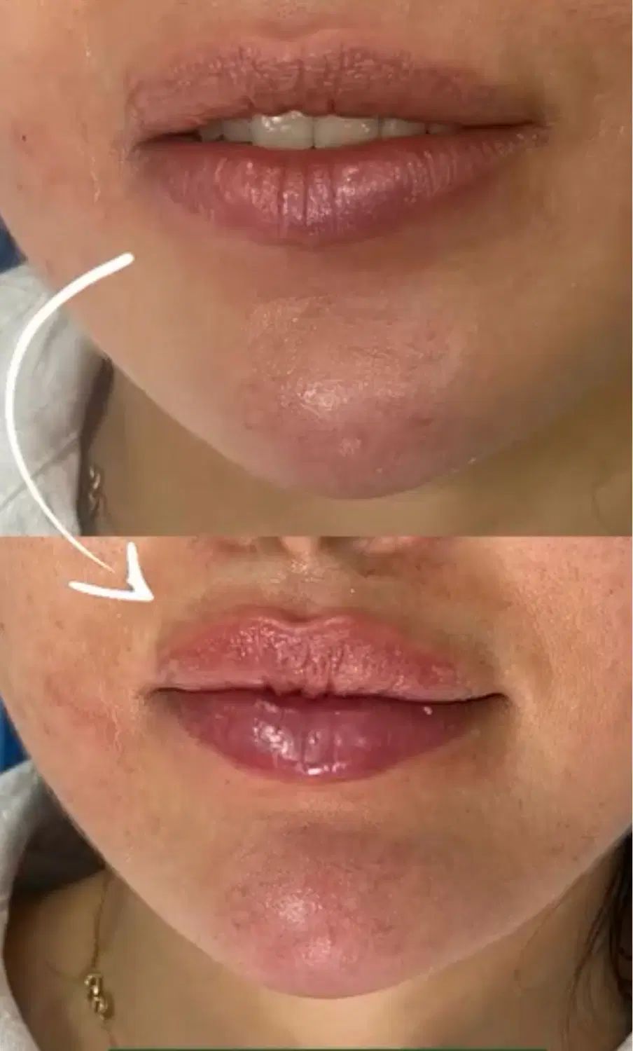 تزریق ژل و بوتاکس و جوانساز و مزوژل فقط هزینه مواد|خدمات آرایشگری و زیبایی|تهران, ونک|دیوار