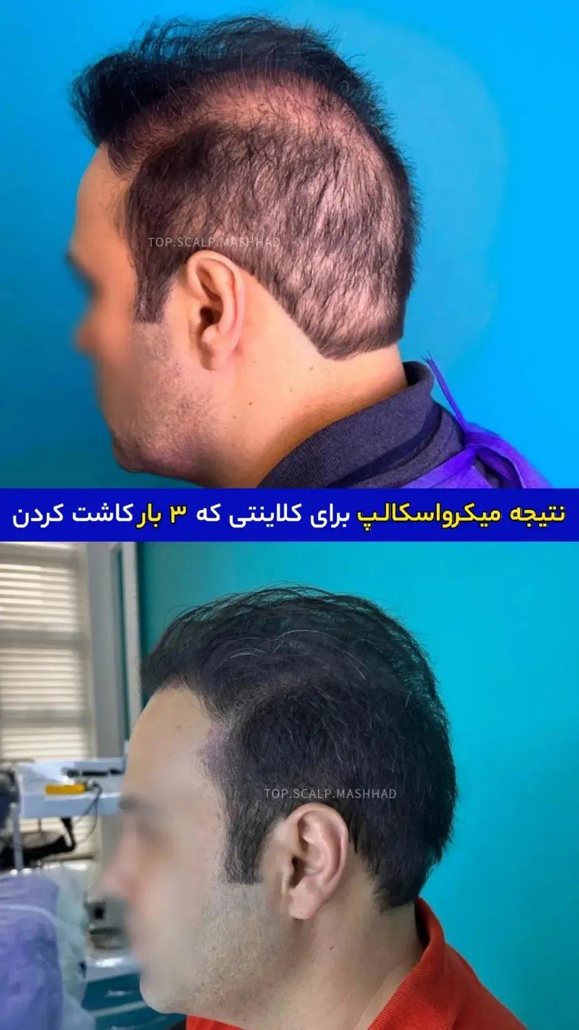 رفع کمپشتی مو با تکنیک میکرو اسکالپ /مکمل کاشتمو|خدمات آرایشگری و زیبایی|مشهد, احمدآباد|دیوار