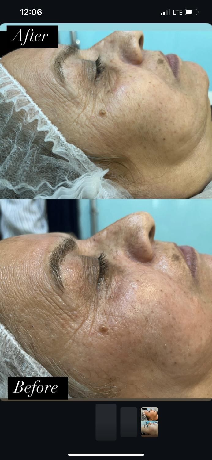 آموزش فشیال صورت. پاکسازی تخصصی و مدل پاکسازی پوست|خدمات آرایشگری و زیبایی|رشت, معلم|دیوار