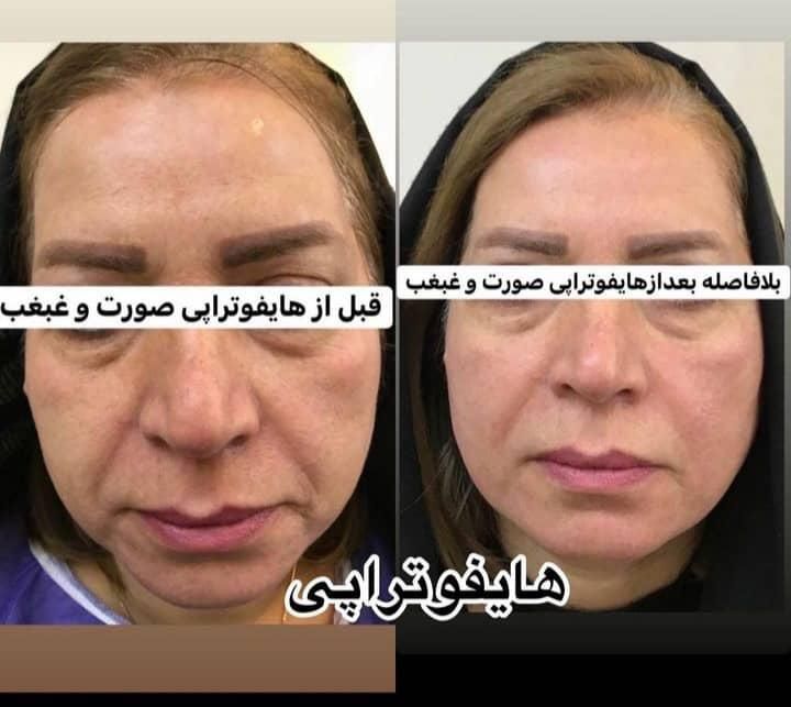 اولین مرکزتخصصی هایفو12بعدی(آراف تخصصی)خوزستان|خدمات آرایشگری و زیبایی|اهواز, زیتون کارمندی|دیوار