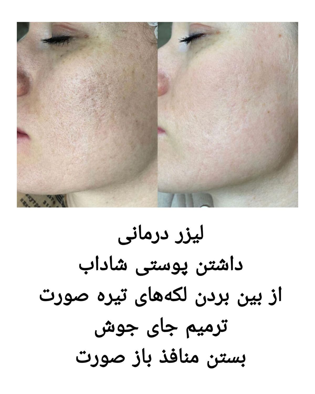 هایفو جوانساز، کیوسوئیچ، ریموو تتو،لیزر موهای زائد|خدمات آرایشگری و زیبایی|آبادان, |دیوار