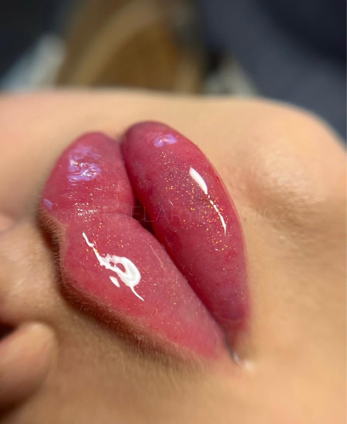 فیلر لب ژل گونه فک بوتاکس لیزرساکشن غبغب کاشت مو|خدمات آرایشگری و زیبایی|رشت, گلسار|دیوار