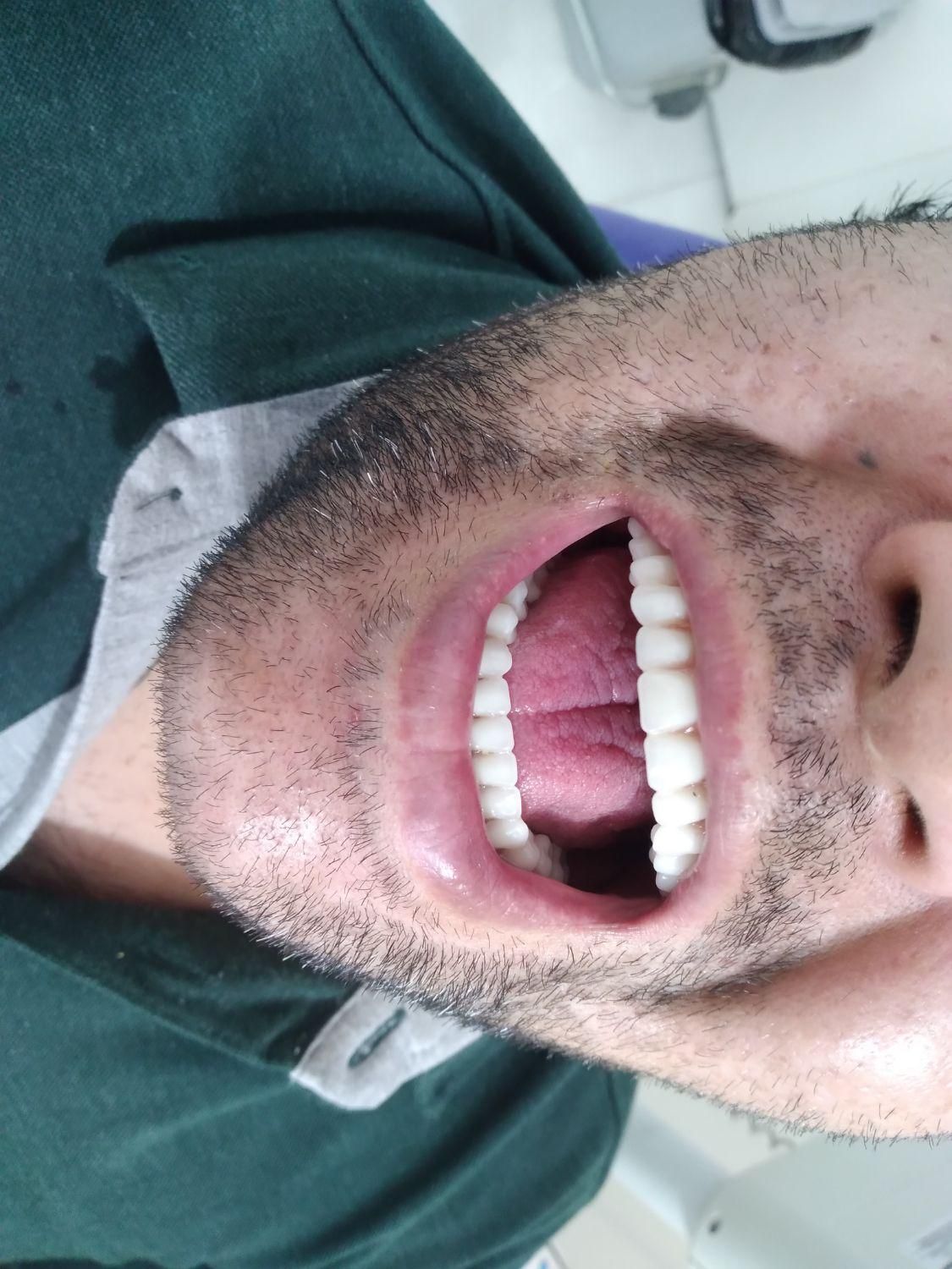 دندانسازی (دندان مصنوعی)پروتز متحرک|خدمات آرایشگری و زیبایی|قم, شاه ابراهیم|دیوار