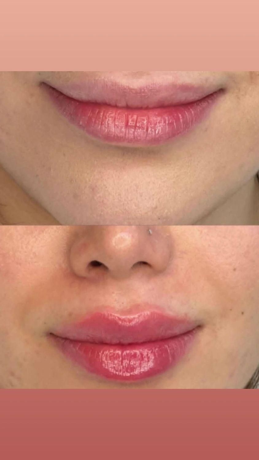 فیلر لب ، خط خنده، زاویه ، مزو فقط ۱۸۰۰|خدمات آرایشگری و زیبایی|محمدیه-قزوین, |دیوار