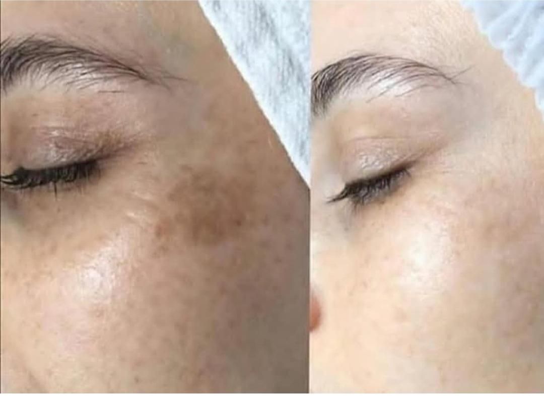 آموزش وخدمات فیشال،پی آرپی،مزوتراپی، مزونیدیلینگ|خدمات آرایشگری و زیبایی|کرج, گوهردشت|دیوار
