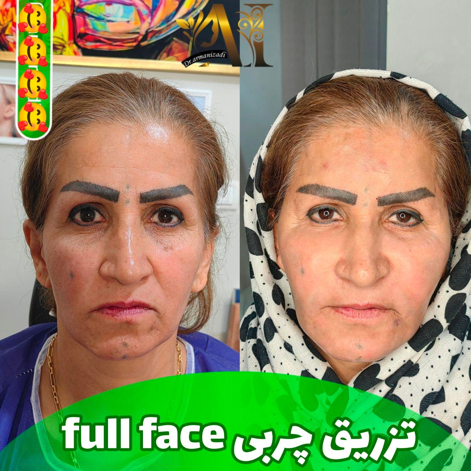 تزریق فیلر بادی ،ساکشن، تزریق چربی صورت و بدن|خدمات آرایشگری و زیبایی|صدرا-فارس, |دیوار