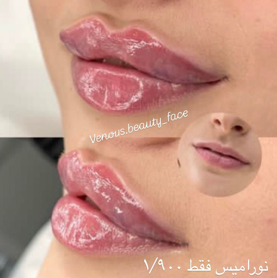 کلینیک لیزر کندلا تزریق ژل لبM رفع گودی سیاهی چشم|خدمات آرایشگری و زیبایی|تهران, صادقیه|دیوار