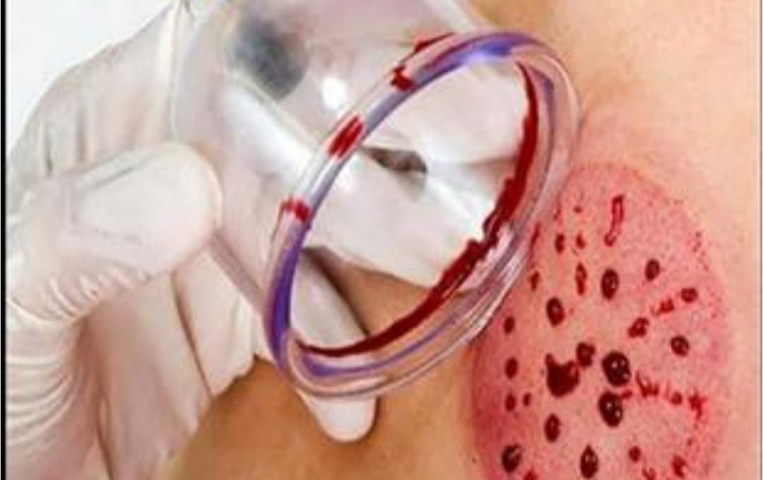 آموزش کارگاهی صفر تا صدحجامت و زالو درمانی|خدمات آموزشی|ارومیه, |دیوار