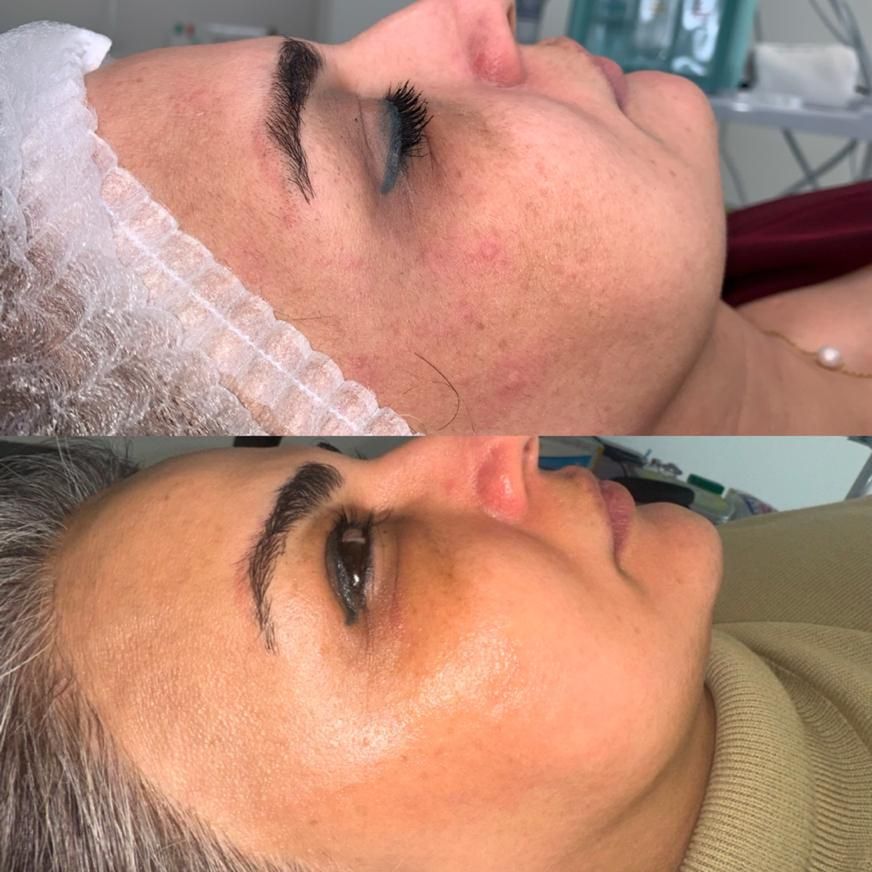 جوانسازی پوست و لیفت صورت|خدمات آرایشگری و زیبایی|تهران, زعفرانیه|دیوار