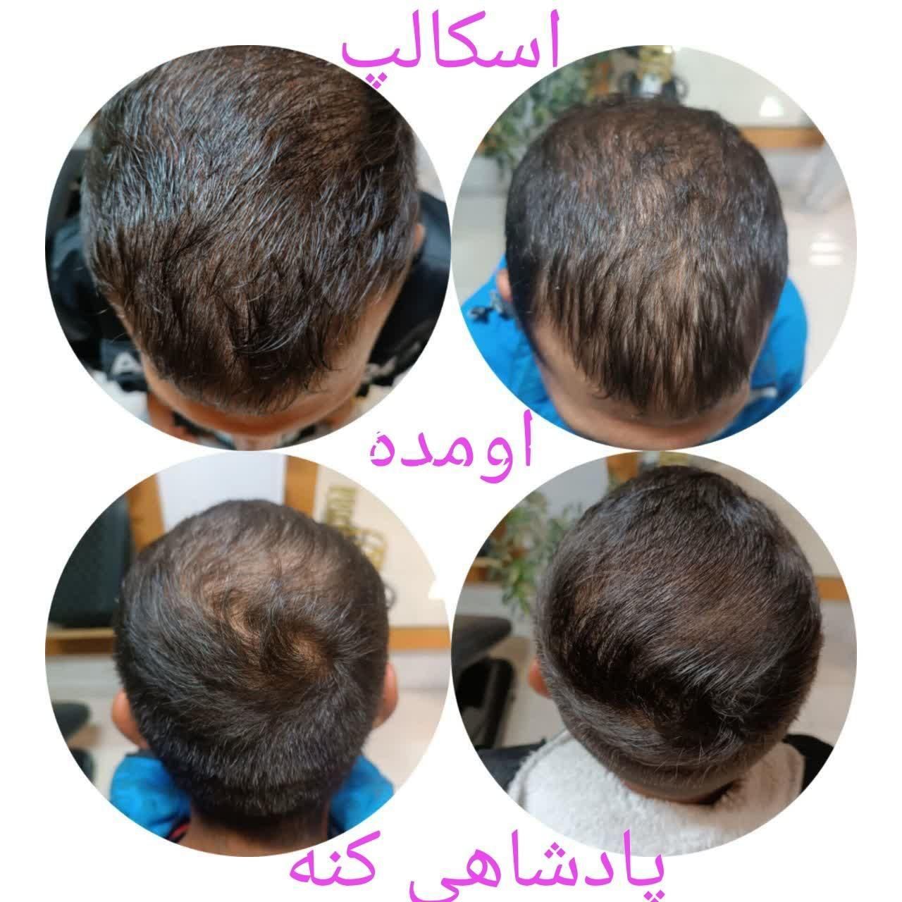 اسکالپ تخصصی در کلینیک پوست مو کاشت میکرو اسکالپ|خدمات آرایشگری و زیبایی|مشهد, شهید فرامرز عباسی|دیوار