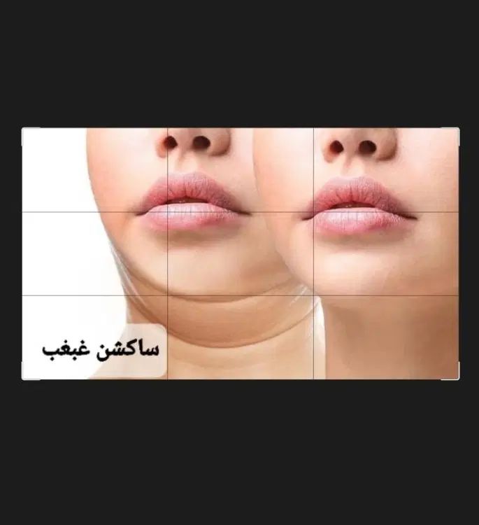 ساکشن غبغب وبوکال فت و چال گونه توسط پزشک در مطب|خدمات آرایشگری و زیبایی|مشهد, شهید فرامرز عباسی|دیوار