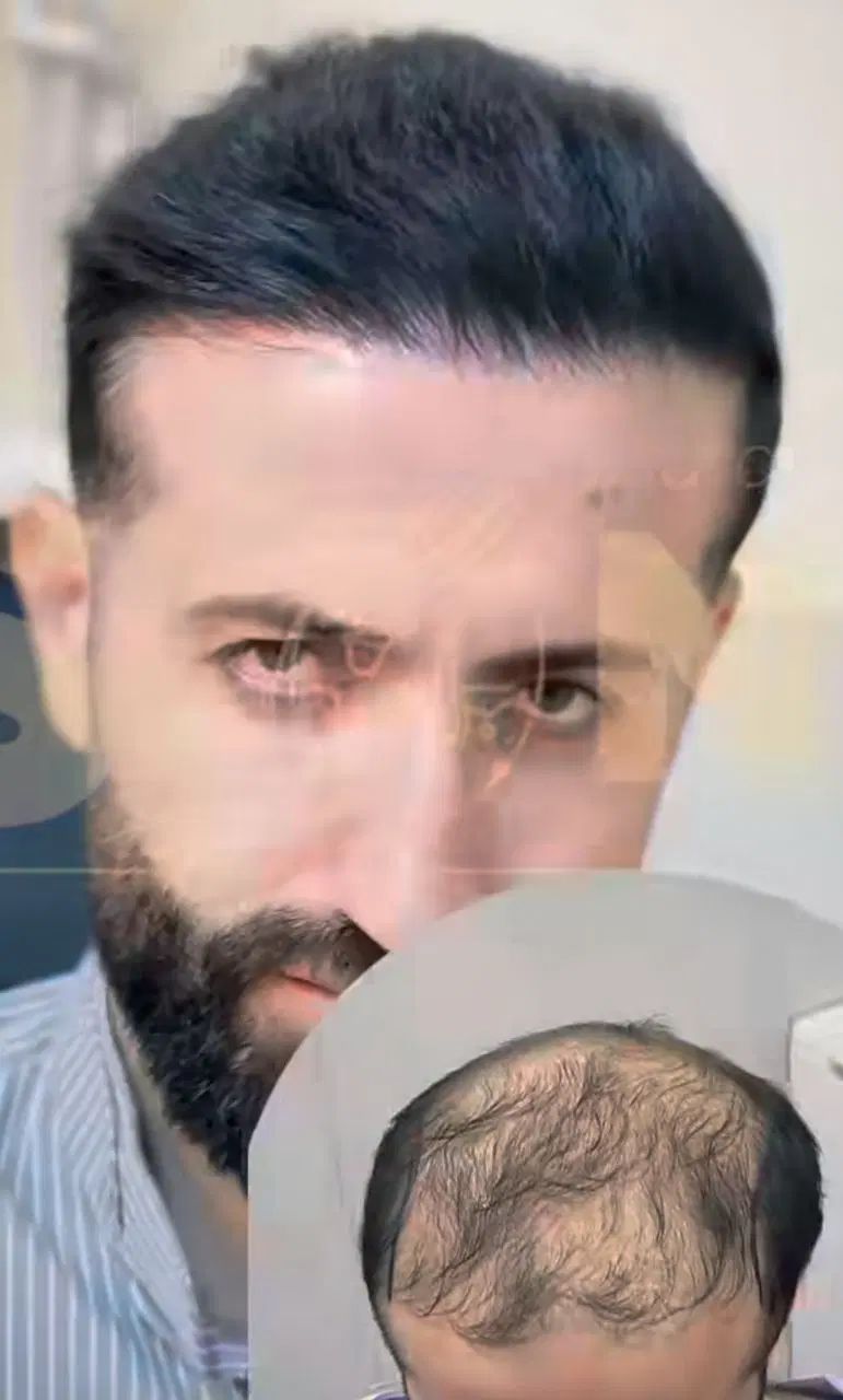 جشنواره کاشت مو و ابرو با تخفیف ویژه|خدمات آرایشگری و زیبایی|تهران, نیاوران|دیوار