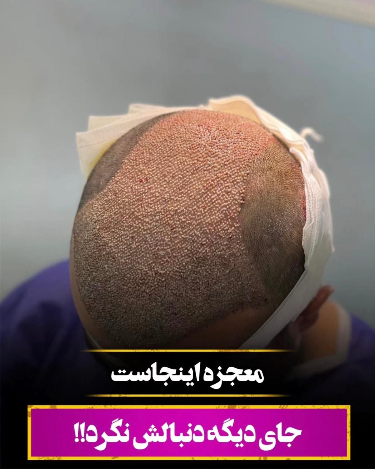 کاشت مو با جدید ترین تکنیک|خدمات آرایشگری و زیبایی|دزفول, |دیوار