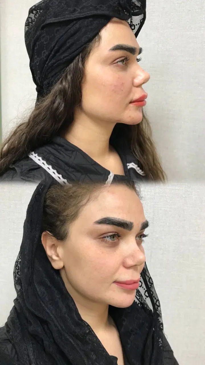 تزریق ژل ،بوتاکس ،لیزر موهای زائد، ساکشن غبعب|خدمات آرایشگری و زیبایی|تهران, صد دستگاه|دیوار