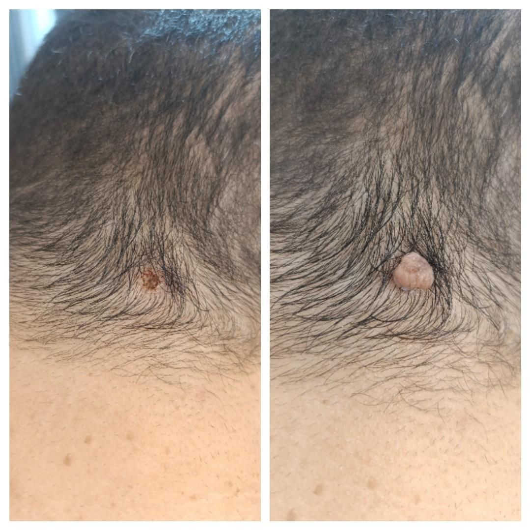 لیزرودرمان زگیل تناسلیhpvخال میخچه،ضایع پوست لک|خدمات آرایشگری و زیبایی|کرج, گلشهر|دیوار