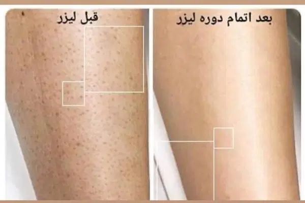 جشنواره ۵۰ درصدی موهای زائد|خدمات آرایشگری و زیبایی|تهران, تهرانسر مرکزی|دیوار