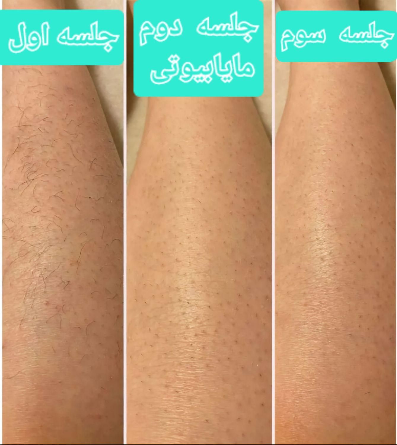 لیزر موهای زائد،مایابیوتی،ضمانت برگشت پول|خدمات آرایشگری و زیبایی|یاسوج, |دیوار