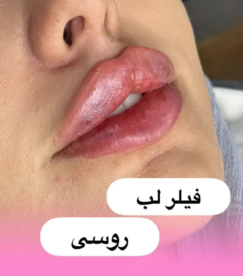 تزریق فیلر و بوتاکس|خدمات آرایشگری و زیبایی|اهواز, گلستان|دیوار