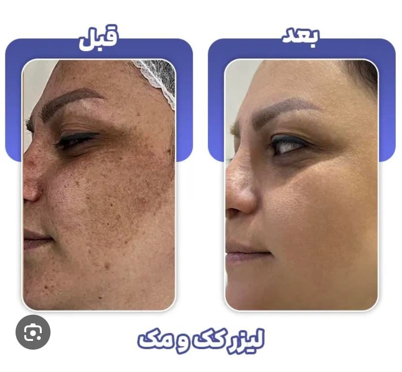 حذف انواع ککومک لک ملاسما و تیرگی در یک جلسه|خدمات آرایشگری و زیبایی|همدان, |دیوار