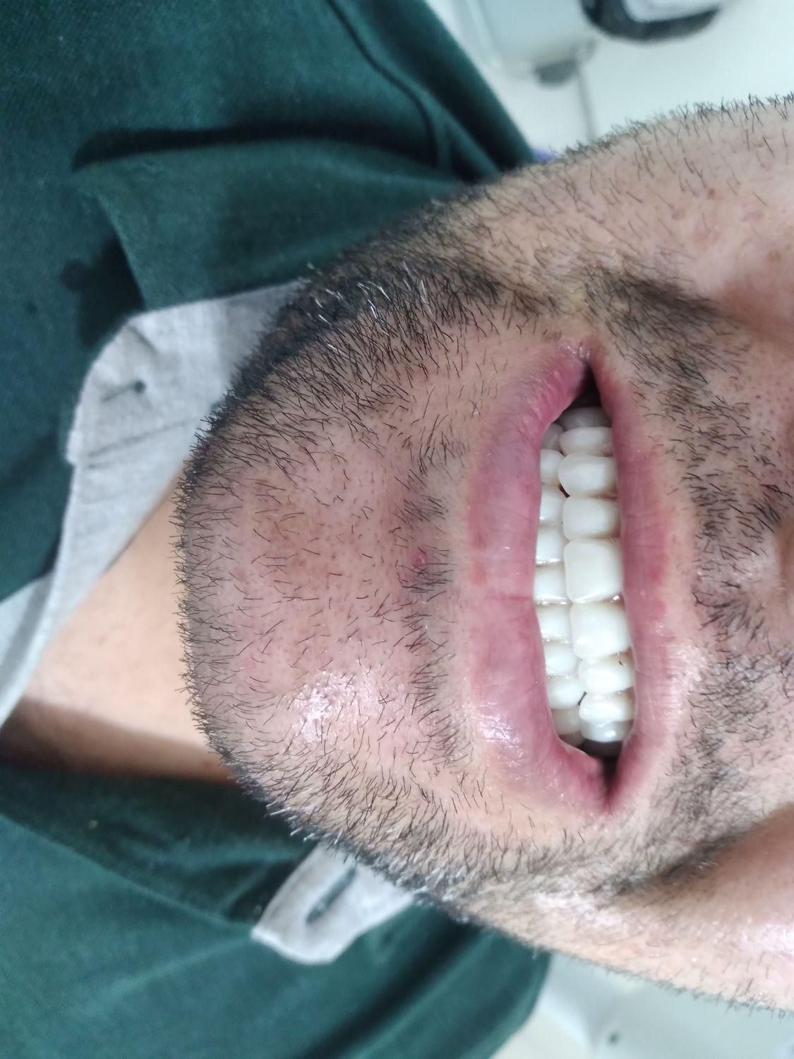 دندانسازی (دندان مصنوعی)پروتز متحرک|خدمات آرایشگری و زیبایی|قم, شاه ابراهیم|دیوار