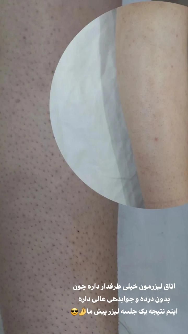 جشنواره تخفیفی لیزر موهای زائد|خدمات آرایشگری و زیبایی|ارومیه, |دیوار