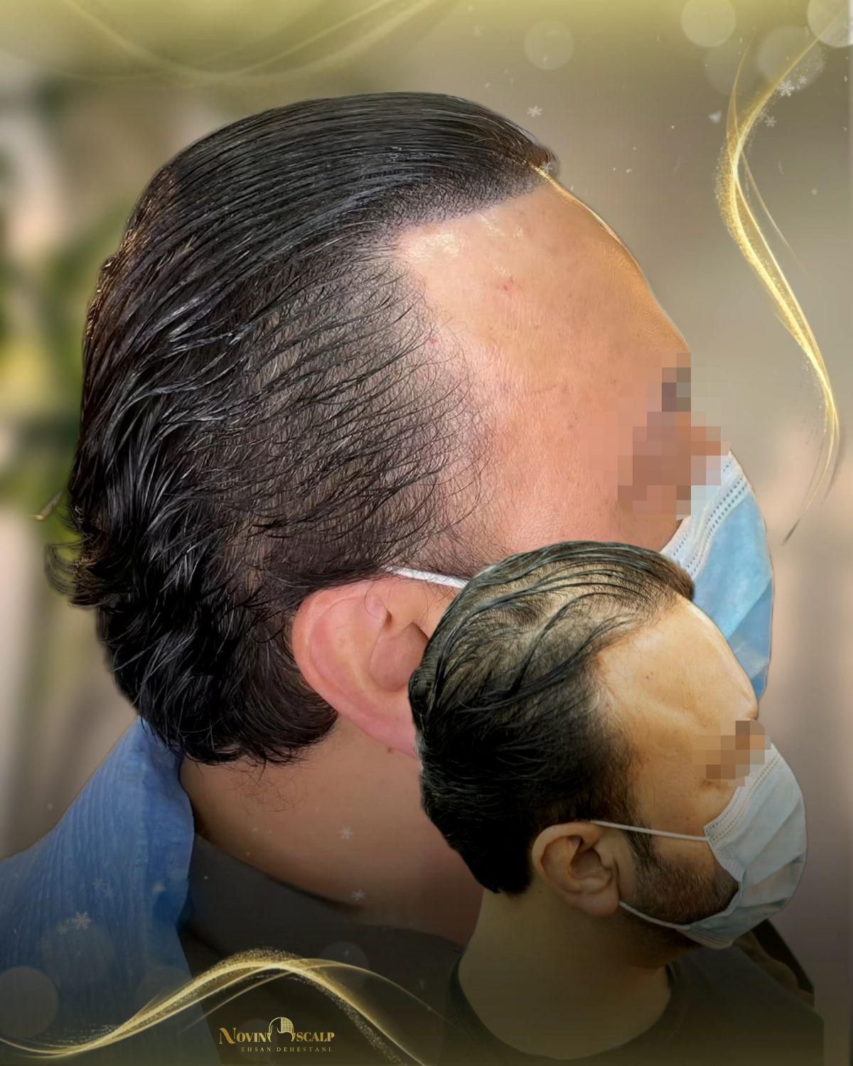 میکرواسکالپ / اسکالپ تخصصی سر/ جایگزین کاشت مو|خدمات آرایشگری و زیبایی|مشهد, وکیل‌آباد|دیوار