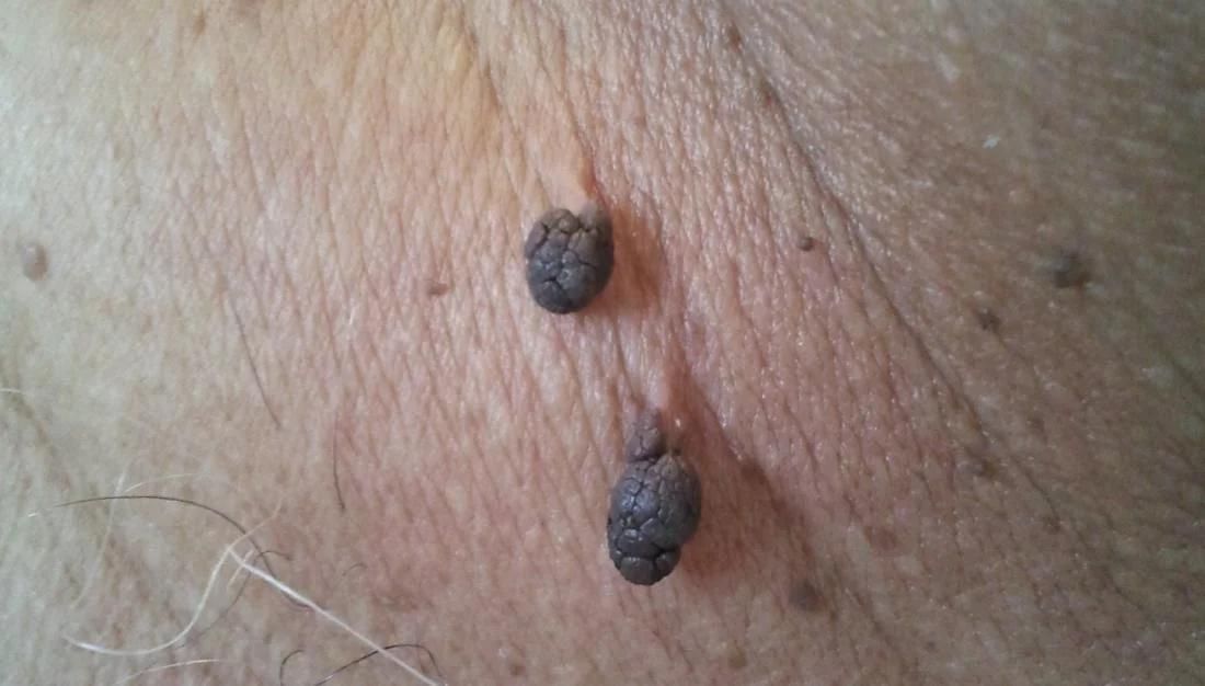 برداشتن خال زگیل گوشت اضاف برداشت زگیل تناسلی|خدمات آرایشگری و زیبایی|شیراز, معالی‌آباد|دیوار