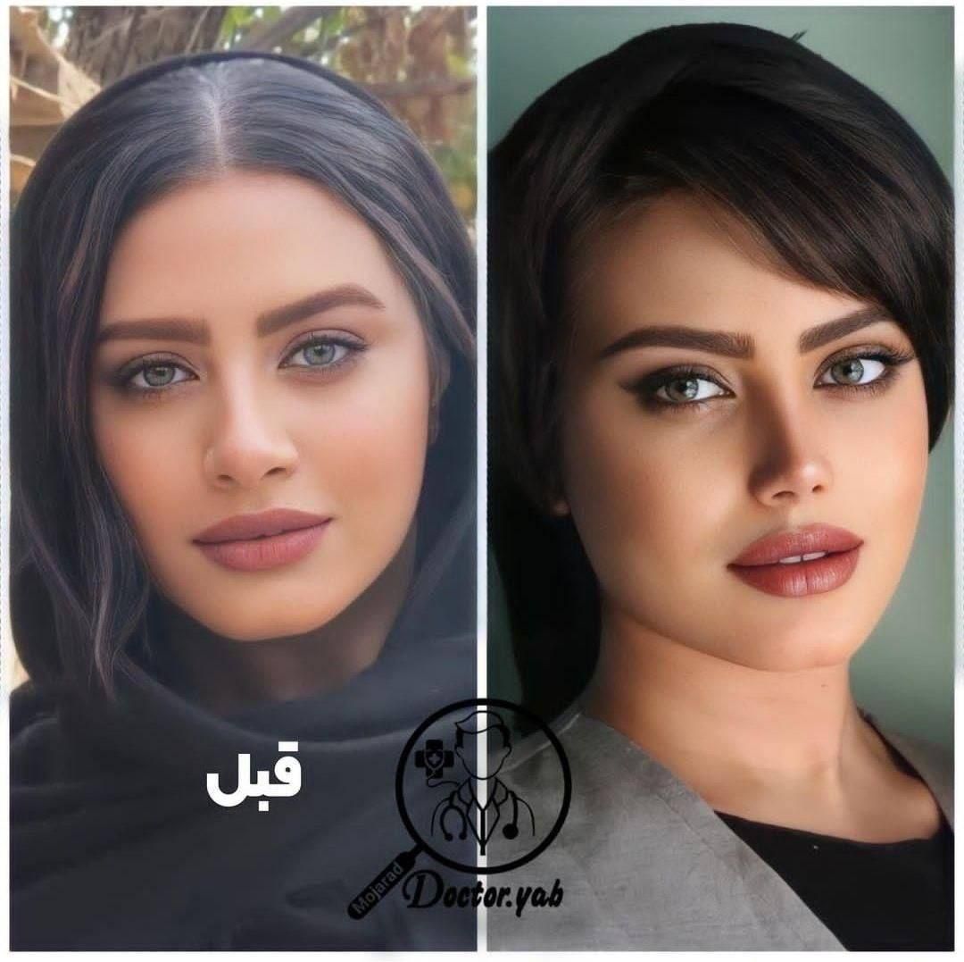 جراحی بینی در شیراز/نوبتگیری +وام+مشاوره|خدمات آرایشگری و زیبایی|لار, |دیوار