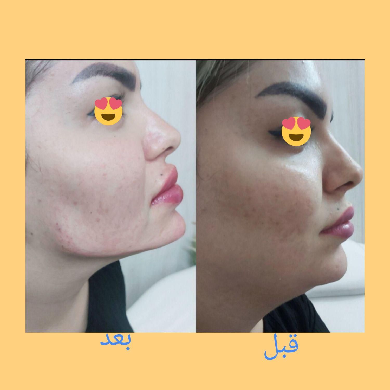 جشنواره تزریق ژل و بوتاکس وانزیم|خدمات آرایشگری و زیبایی|ملارد, |دیوار