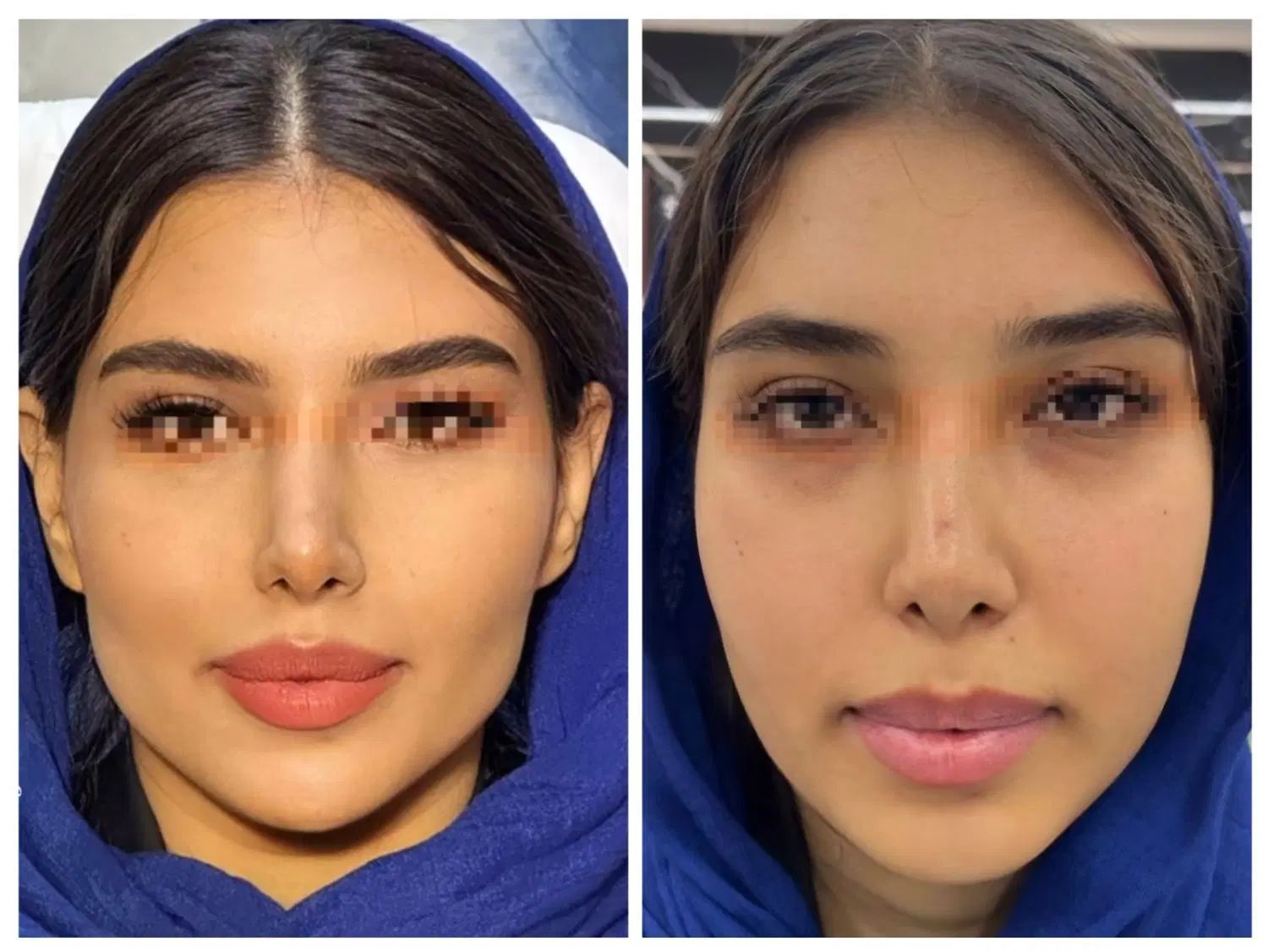 مرکز تخصصی فرم دهی و‌لیفت بینی و صورت با نخ و‌ژل|خدمات آرایشگری و زیبایی|مشهد, احمدآباد|دیوار