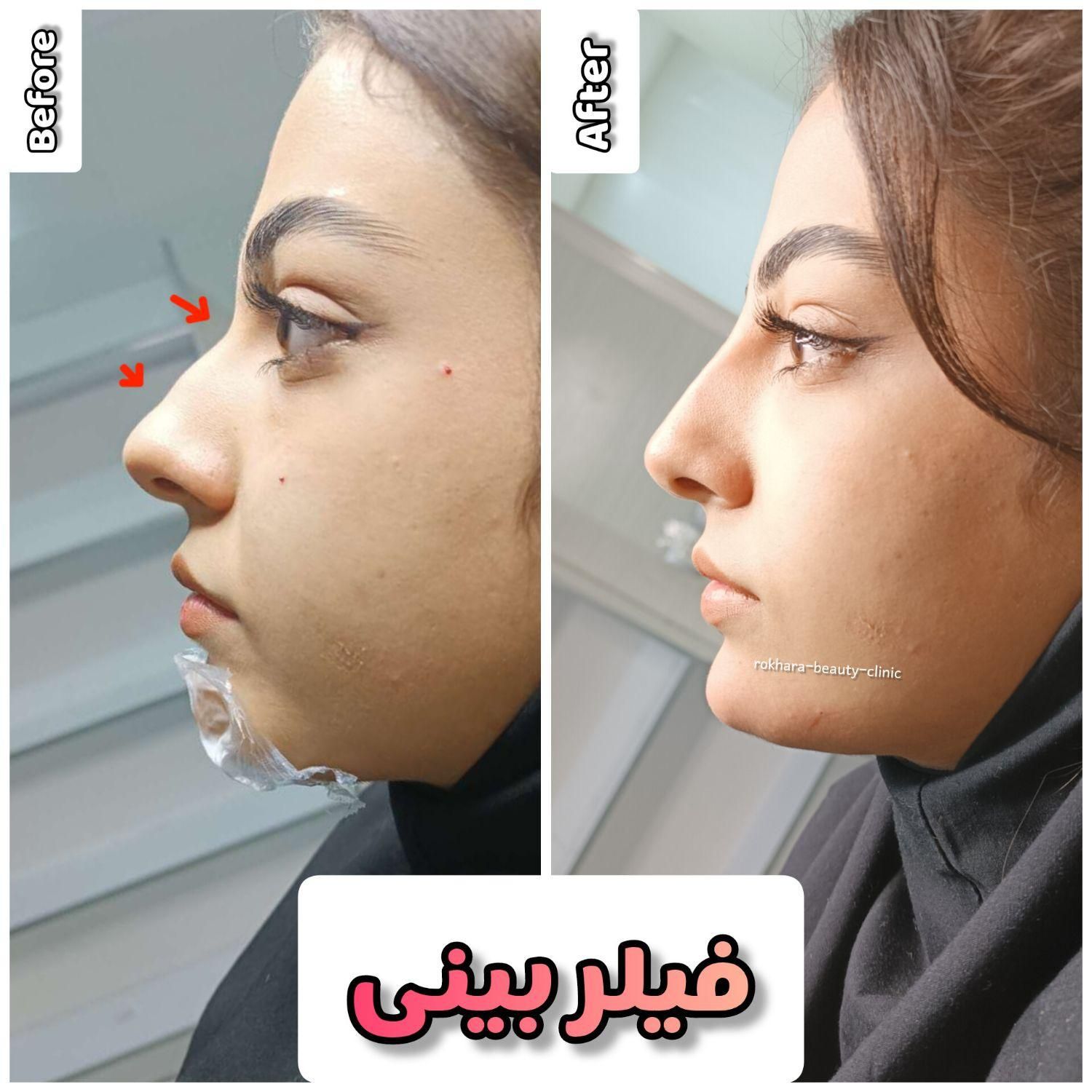 فیلرژل لب،ژل وبوتاکس تخصصی آقاوخانم در مطب پزشک|خدمات آرایشگری و زیبایی|شیراز, قصرالدشت|دیوار