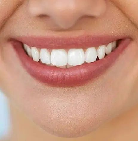 دندانپزشکی کامپوزیت لامینت قسطی|خدمات آرایشگری و زیبایی|مشهد, کوشش|دیوار