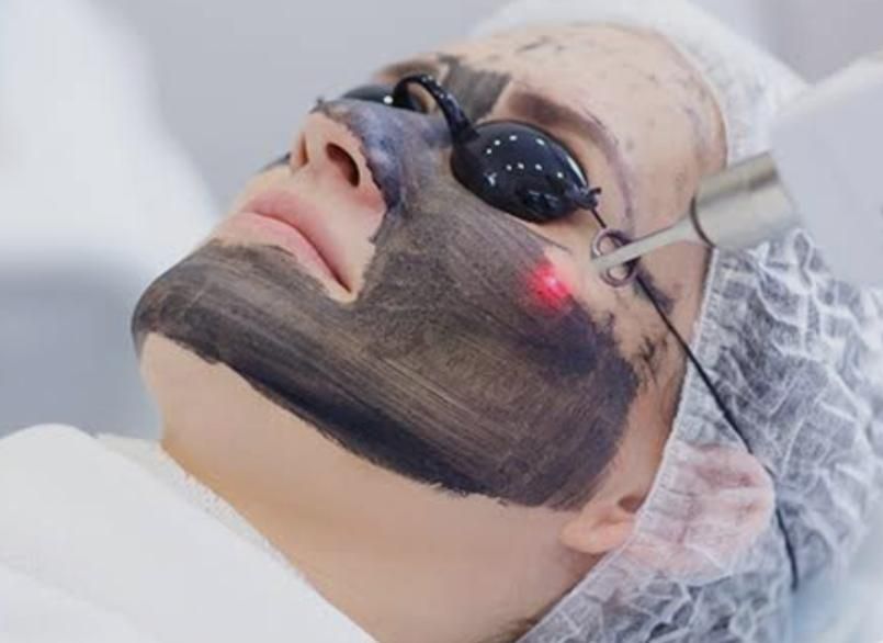 ریمو تتو.پیلینگ کربن هالیوودی. حذف کک مک|خدمات آرایشگری و زیبایی|اسلامآباد غرب, |دیوار