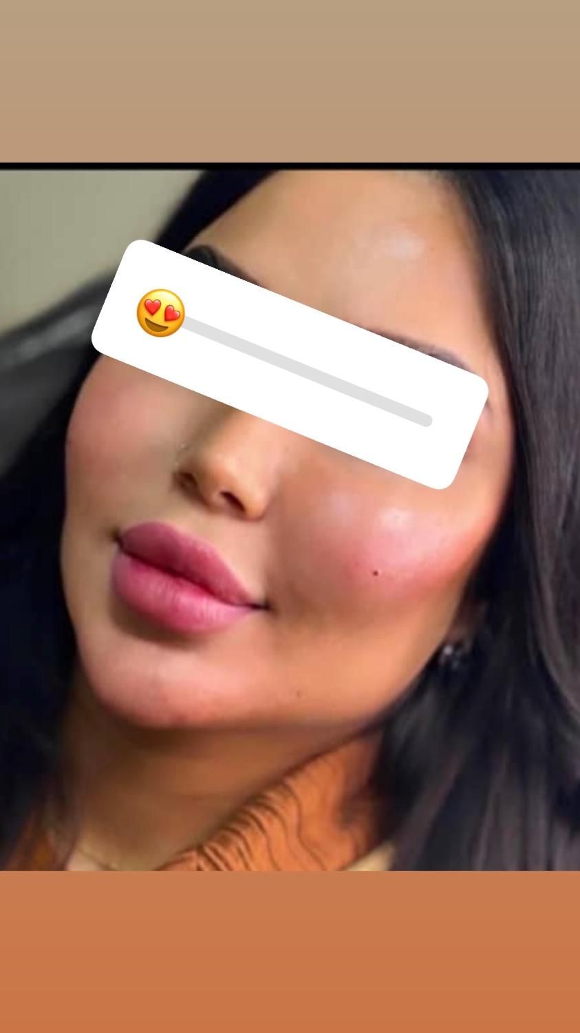 اف ویژه ژل بوتاکس بندرعباس|خدمات آرایشگری و زیبایی|بندرعباس, |دیوار